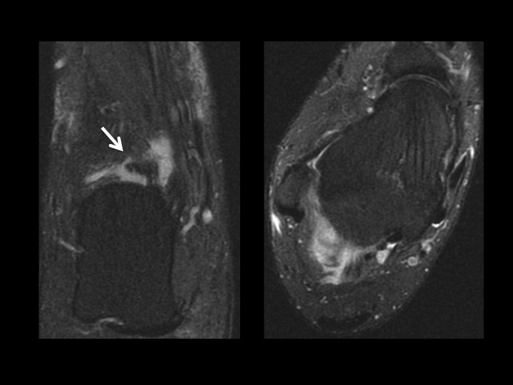 Figure 4 for case talocalcaneal joint ( RID3030 )